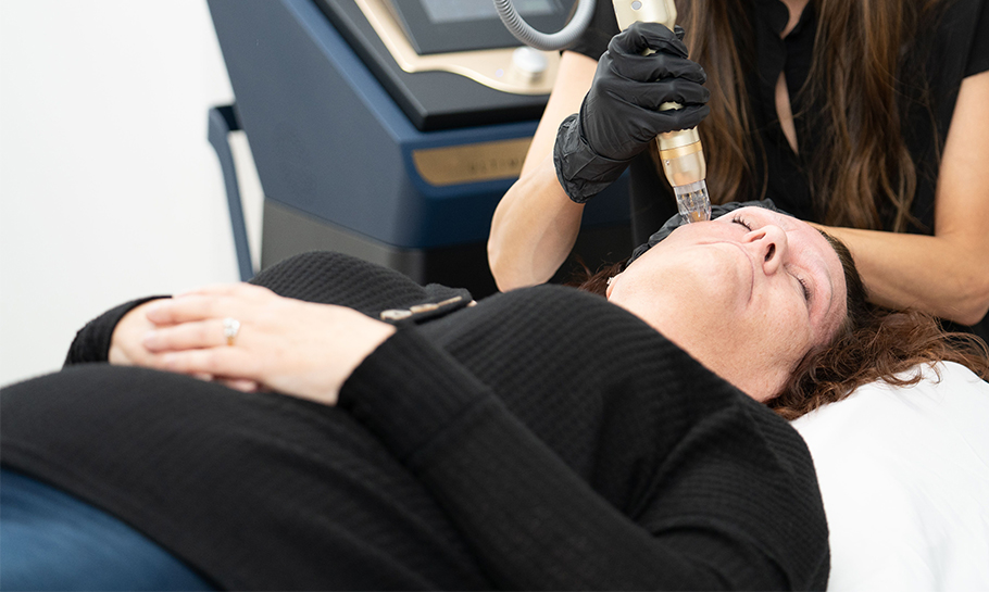 SIH Radiofrequency Microneedling